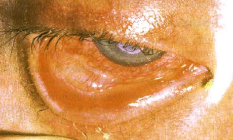 Sindrom Stevens-Johnson. Konjungtivitis desquamative dua hala dengan kawasan nekrosis. Keratitis yang teruk, yang menyebabkan parut pada kornea. Keadaan menjadi rumit dengan penambahan sindrom mata kering.