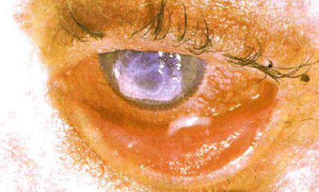 Sindrom Stevens-Johnson. Konjungtivitis desquamative dua hala dengan kawasan nekrosis. Keratitis yang teruk, yang menyebabkan parut pada kornea. Keadaan menjadi rumit dengan penambahan sindrom mata kering.