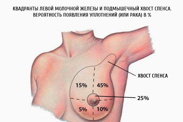 Quadrants dari payudara kiri dan spiral axillary dari spence.  Kemungkinan anjing laut (atau kanser) dalam%