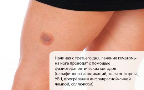 Rawatan hematoma pada kaki
