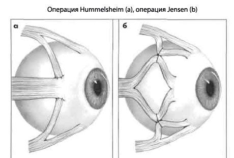 Strabismus - Operasi