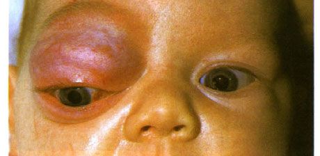 Hemangioma kapilari bahagian anterior orbit dan kelopak mata bahagian atas.  Neoplasma cenderung untuk maju