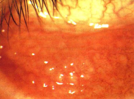 Konjunktivitis folikular akut kanak-kanak dengan pelbagai luka daripada moluskum contagiosum