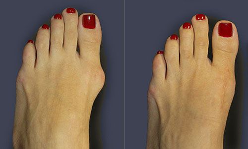 Bunion