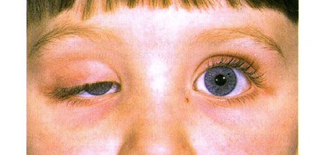 Ptosis kongenital unilateral