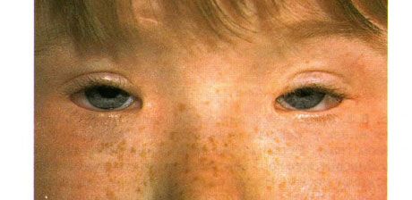 Sindrom blepharophimosis.  Ptosis yang dikendalikan oleh dua belah pihak, telecanthus dan blepharophimosis