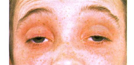 Ophthalmoplegia luar.  Ptosis dua belah.  Pesakit membuka matanya dengan menaikkan alisnya