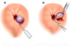 Rawatan Pembedahan Buasir Luar