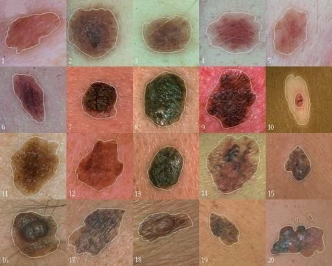 Para saintis telah menemui gen yang memainkan peranan penting dalam perkembangan melanoma