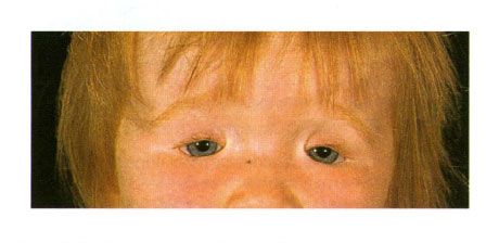 Koloboma dua sisi kelopak mata pada kanak-kanak dengan sindrom Golden.  Penutupan celah mata di sebelah kiri