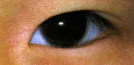Epiblypharon.  Pertumbuhan bulu mata yang tidak betul disambut sejak lahir.  Kadang-kadang terdapat peningkatan secara spontan